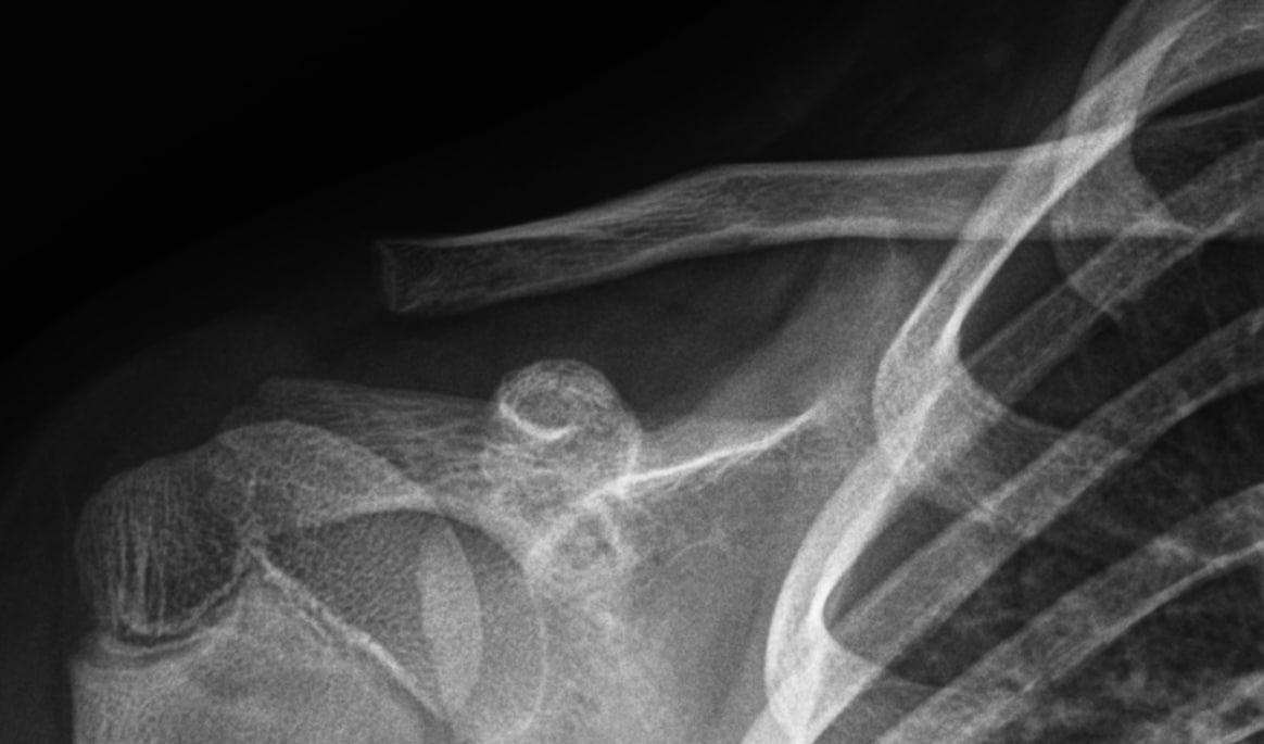 소아 어깨/쇄골 X-ray. 개인정보 오버레이는 보이지 않음. 쇄골 원위부/간부 경계 부위 피질 연속성 변화가 의심되어 clavicle frac...